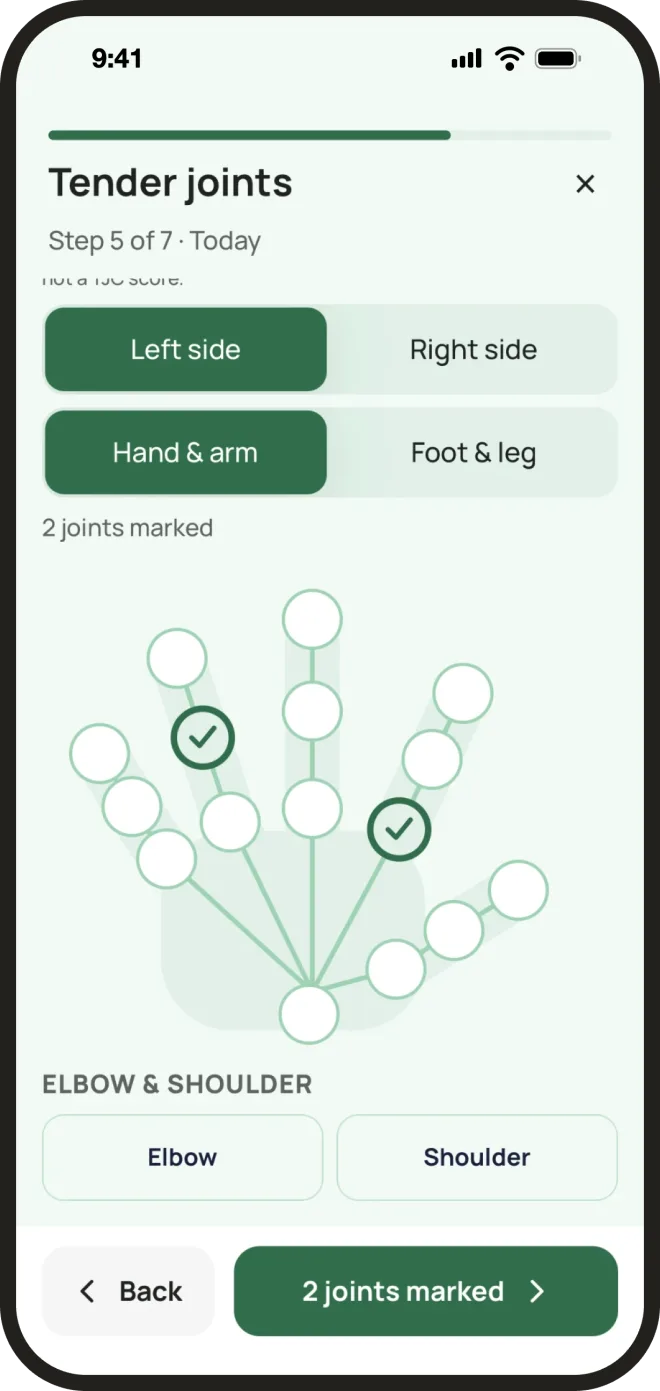 The body map in the FlareEase app: an outline of a hand with its joints, two of them marked as tender